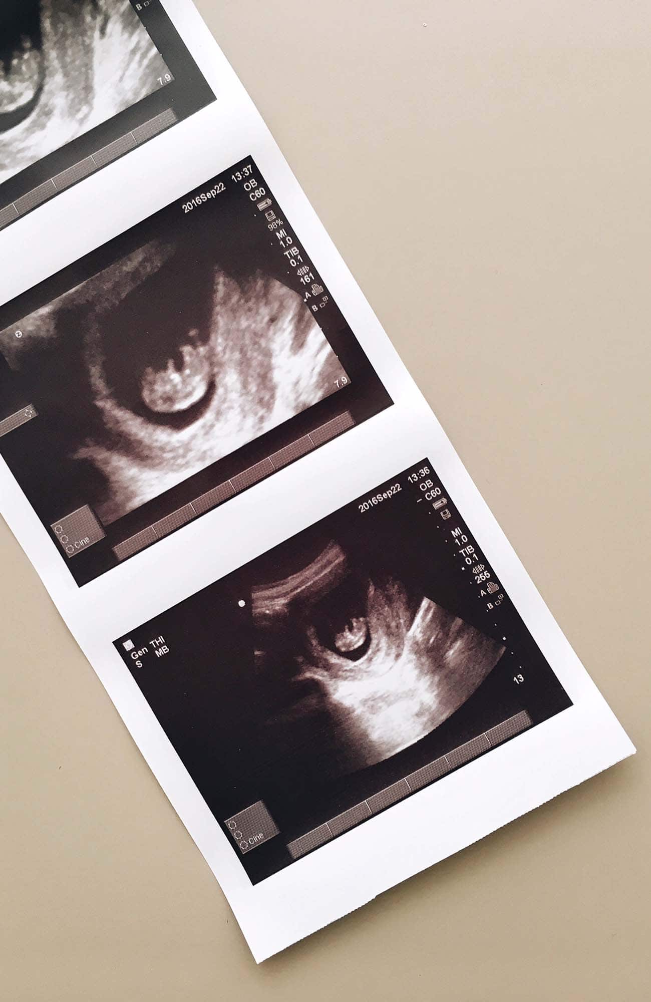 ultrasound printed images